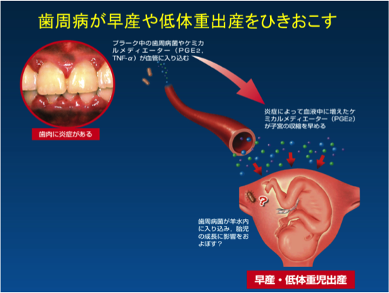 子宮異常収縮